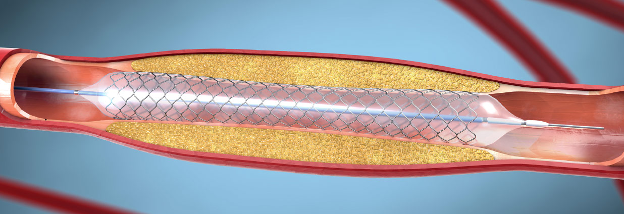 Interventional Cardiology